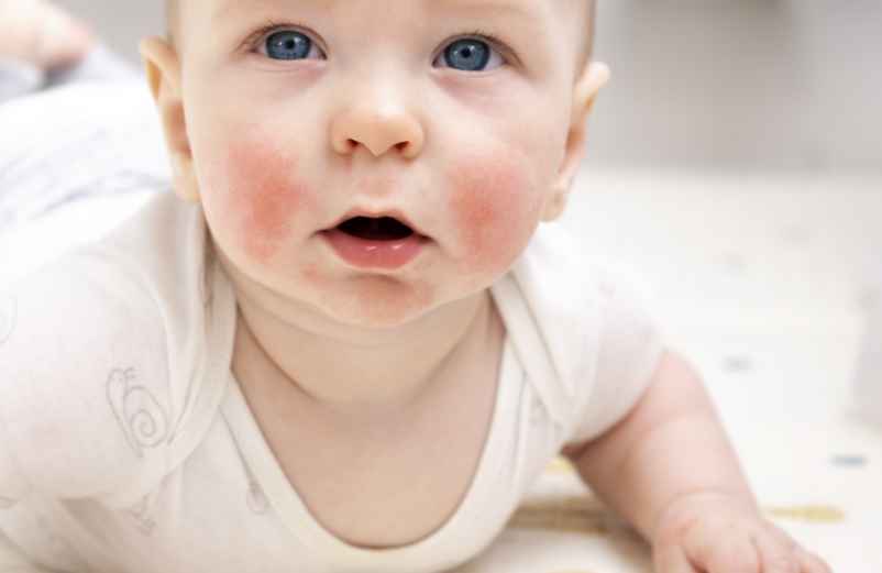 Boutons de chaleur chez bébé : quel traitement pour les soulager ?-L'enfant dans la nature