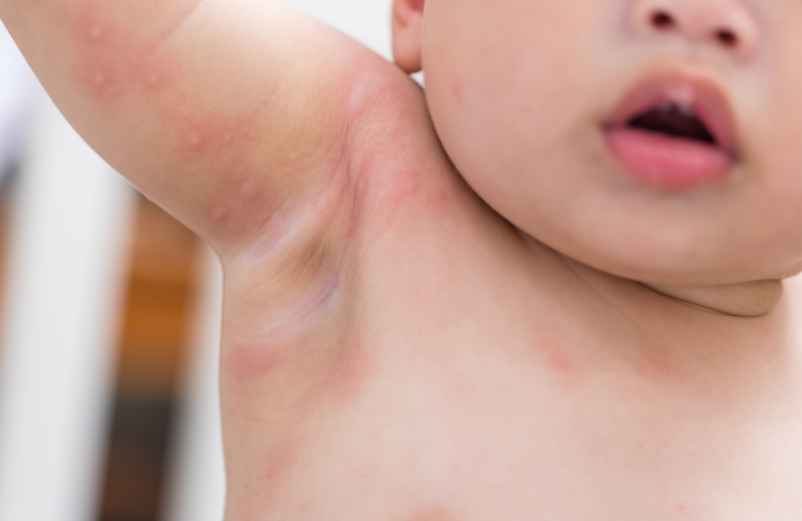 Comprendre l'origine des boutons de chaleur-L'enfant dans la nature Comprendre l'origine des boutons de chaleur-L'enfant dans la nature